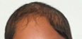 girl scalp